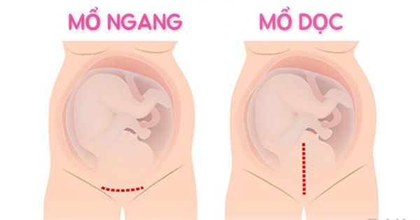 Sinh mổ 2 lần lần 3 có sinh thường được không