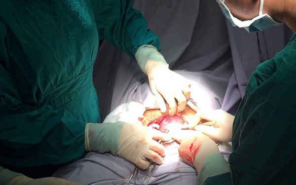 sinh-mo-lan-3 Sinh mổ lần 3