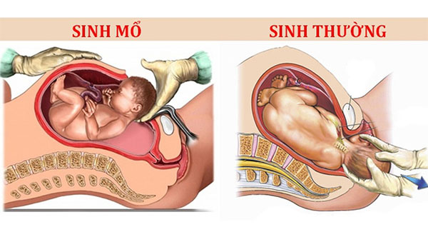 Sinh thường hay sinh mổ