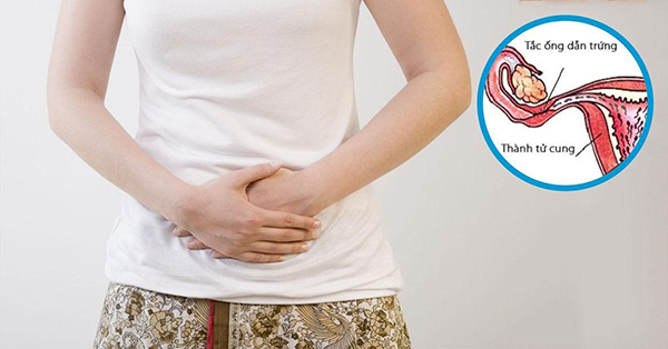 tac-ong-dan-trung1 Ống dẫn trứng bị tắc gây ra nhiều hệ lụy, đặc biệt là chức năng sinh sản