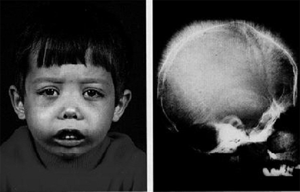 tan-mau-bam-sinh-thalassemia Tan máu bẩm sinh thalassemia