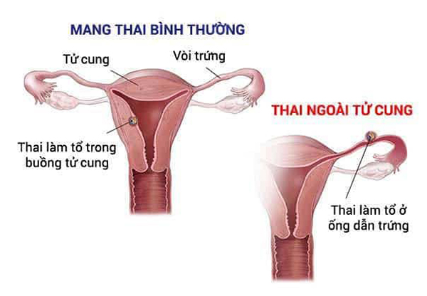 Thai chưa vào tử cung