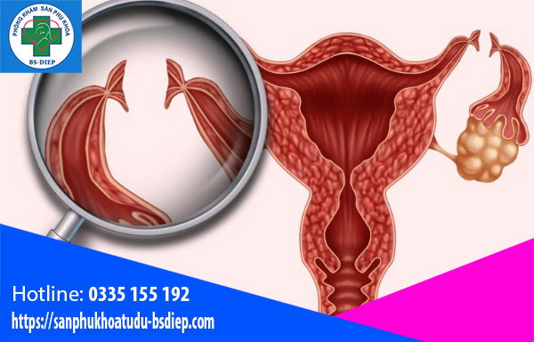 that-ong-dan-trung-co-anh-huong-gi-khong Thắt ống dẫn trứng có ảnh hưởng gì không?