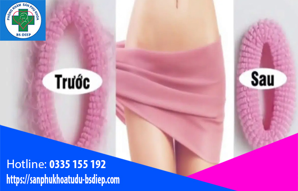 Thu hẹp vùng kín khi nào