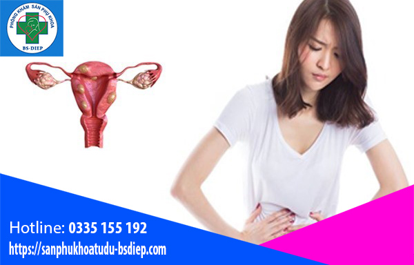 Triệu chứng u xơ tử cung
