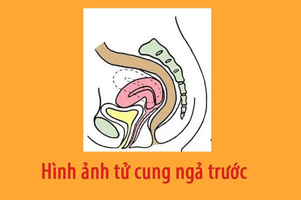 Hiện tượng tử cung ngả trước