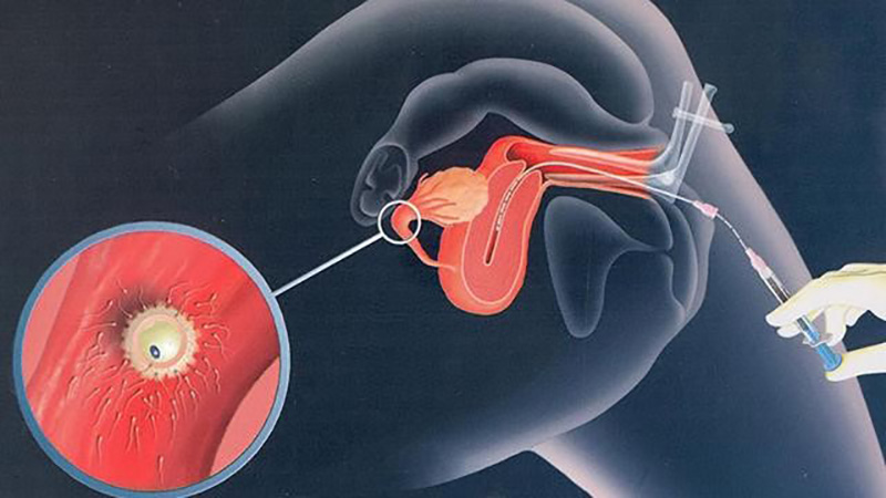 Tuổi tác là nguyên nhận khiến bơm tinh trùng thất bại