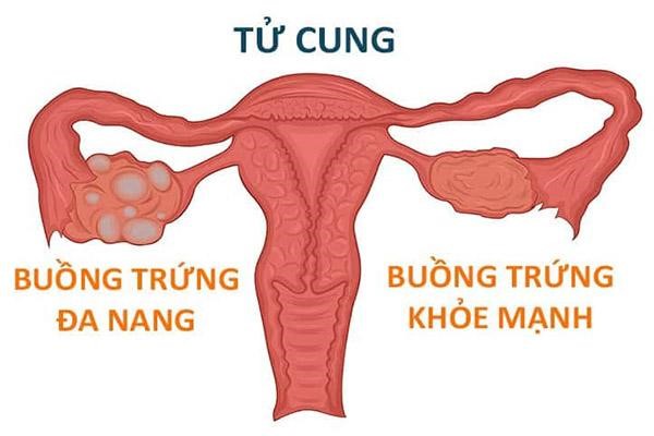 u-nang-buong-trung-ac-tinh U nang buồng trứng ác tính