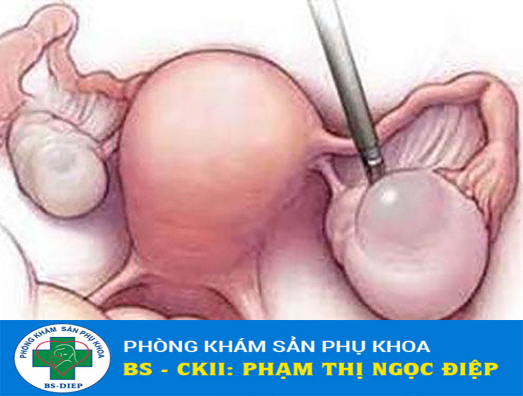 u-nang-buong-trung-co-nguy-hiem-khong U nang buồng trứng có nguy hiểm không