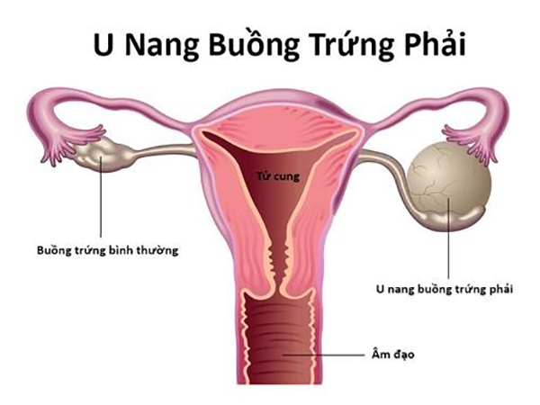 Buồng trứng bên phải xuất hiện u nang 40mm