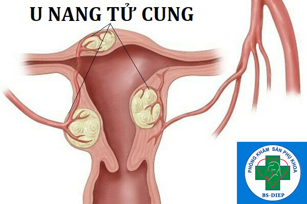 u-nang-tu-cung U nang tử cung