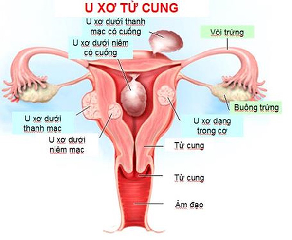 U xơ tử cung