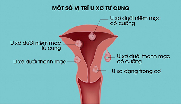 vi-tri-nhan-xo-tu-cung Vị trí nhân xơ tử cung