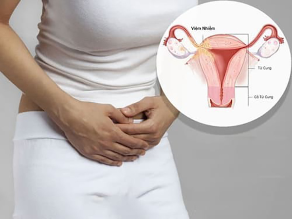 viem-phan-phu Viêm phần phụ