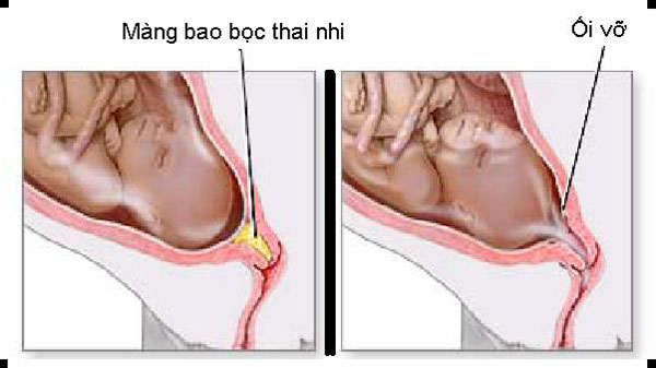Vỡ ối