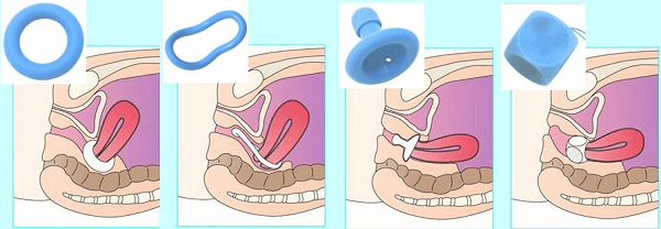 Vòng nâng cổ tử cung