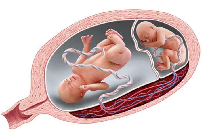 Xác định hội chứng truyền máu song thai