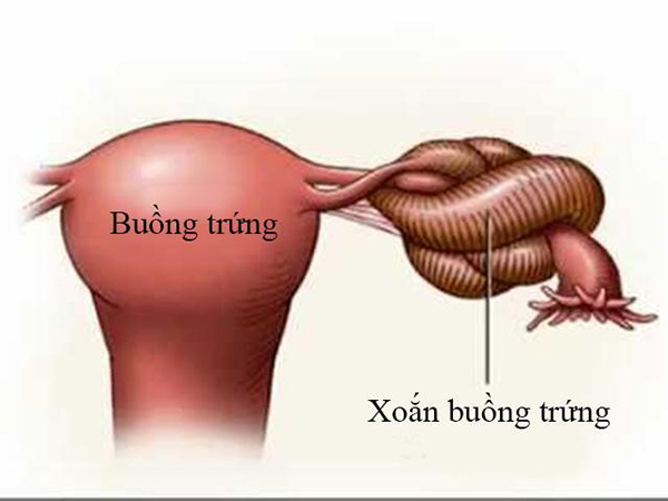 xoan-ong-dan-trung-do-u-nang Xoắn ống dẫn trứng do u nang