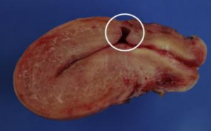 khuyết sẹo mổ lấy thai