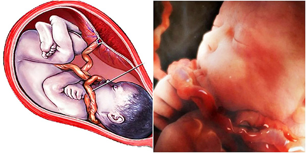 Dây rốn quấn cổ